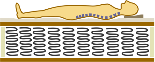 Схематичное изображение человека лежащего на жёстком матрасе на независимых пружинах. Излишняя жёсткость возникшая от применения слоёв койры не даёт проявиться ортопедическим свойствам матраса