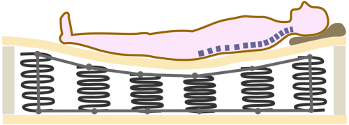 Схематичное изображение позвоночника человека лежащего на матрасе с нежелательным эффектом гамака